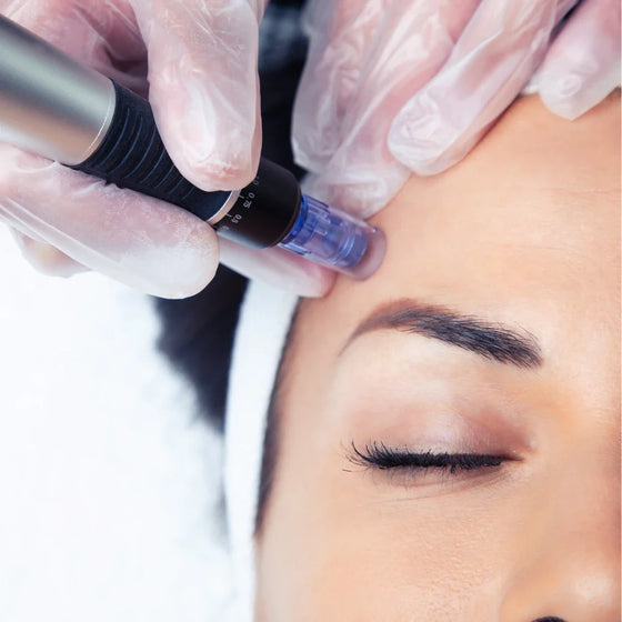 Microneedling y Mesoterapia Virtual