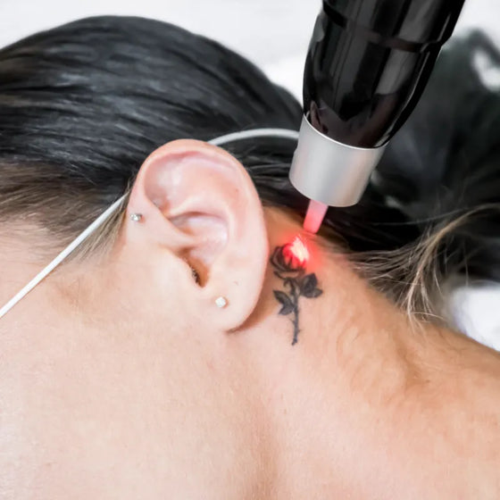 Eliminación tatuajes