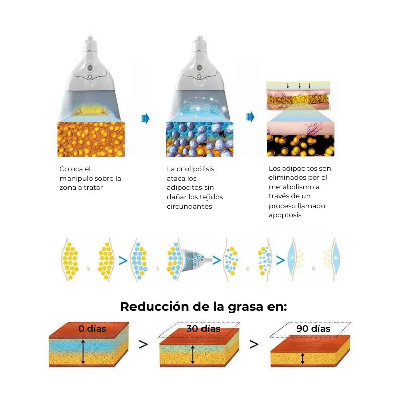 Criolipólisis RSCP 4 Manípulos W025