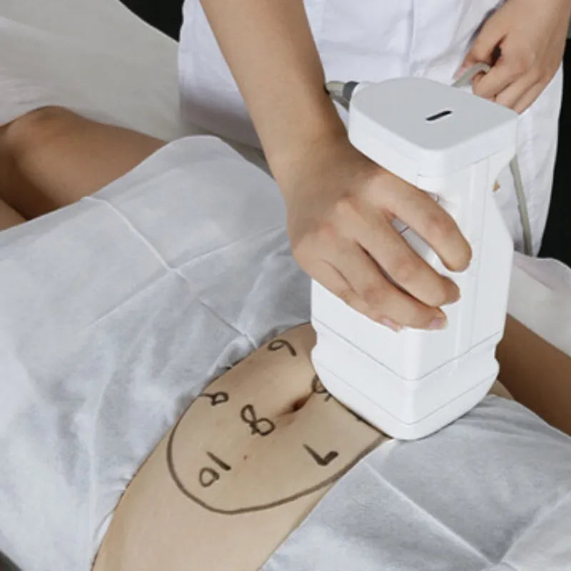HIFU 7D + Liposonix + Radiofrecuencia Fraccionada RS F58