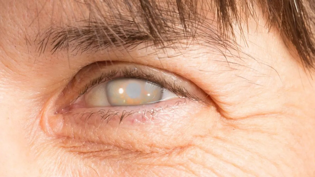 Ceguera por uso de láser sin gafas de protección