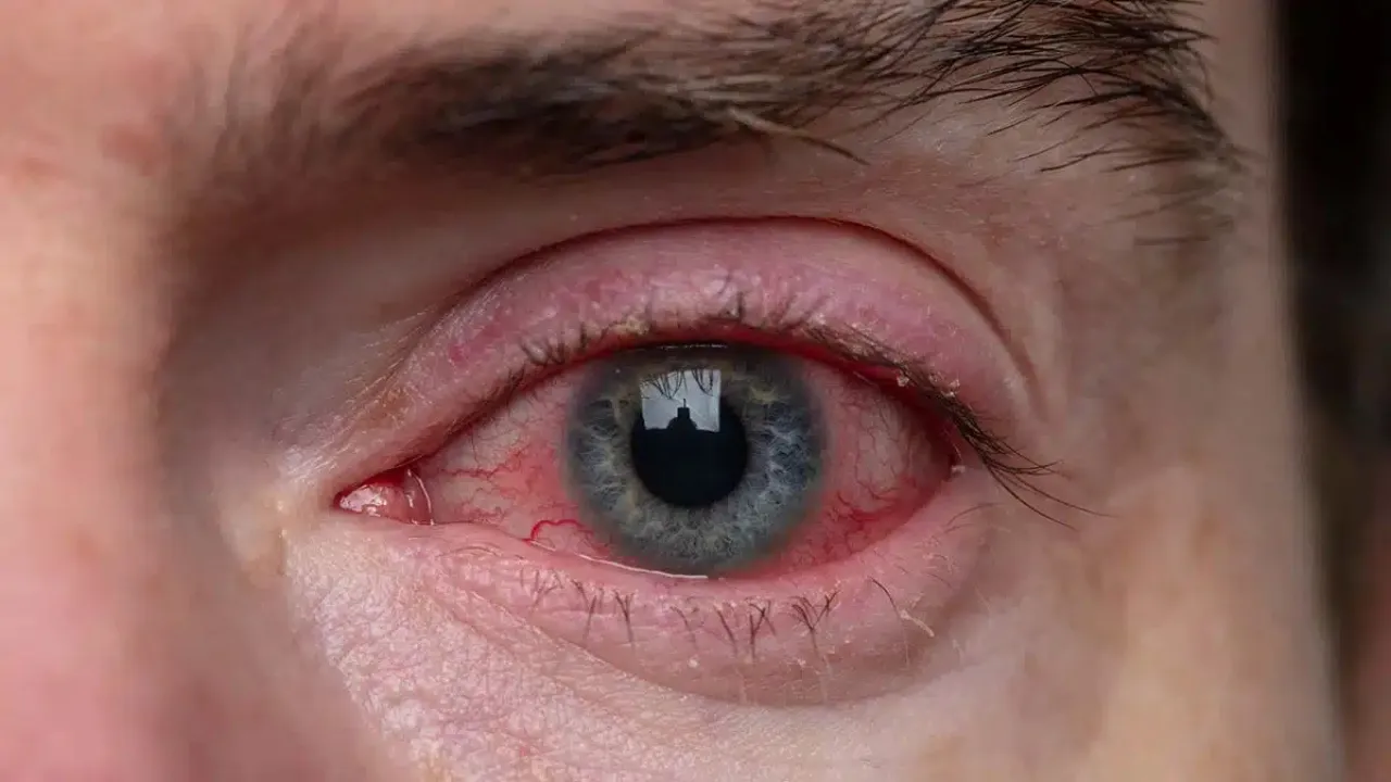 Quemadura de retina por uso de láser sin gafas de protección